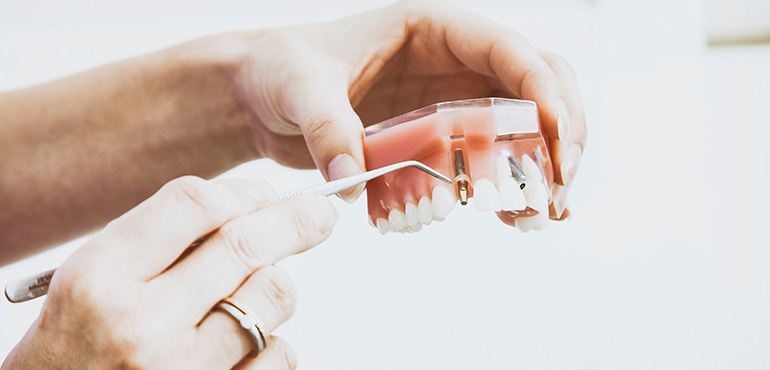 implant stomatologiczny